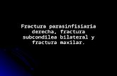 Fracturas Parasinfisiaria Derecha, Subcondilea Bilateral y Maxilar