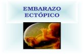 EMBARAZO ECTÓPICO. DEFINICIÓN En un embarazo normal, el óvulo fecundado por el espermatozoide recorre la trompa de Falopio hasta la cavidad del útero: