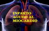 INFARTO AGUDO AL MIOCARDIO. La sangre llega a los ventrículos viajando a las válvulas aurículas ventriculares, la mitral en el lado izquierdo, y la tricúspide.