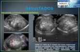 NEUROBLASTOMA SUPRARRENAL CASO 11. Niña de 6 meses con masa suprarrenal derecha compatible con neuroblastoma. Ecografía al debut, donde se visualiza una.