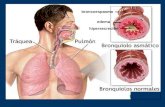 ASMA BRONQUIAL.- Definicion (73 palabras) El asma es una alteración inflamatoria crónica de la vía aérea en la que intervienen muchas células y elementos.