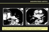 Como ejemplos de patología aórtica dócil al tratamiento endovascular se muestran dos imágenes TC angio MPR axial de (A) disección aórtica y (B) úlcera.
