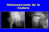 Osteonecrosis de la Cadera. Vascularización del extremo superior del fémur.