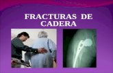 FRACTURAS DE CADERA. La Cadera La cadera es la articulación donde se une el hueso del muslo con el de la pelvis. Las caderas son articulaciones en rótula.
