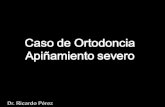 Caso de Ortodoncia con severo apiñamiento