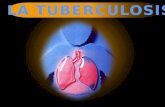Tuberculosis nivel medio