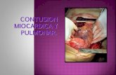 Contusion Miocardica