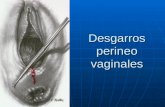 Expo Desgarros Perineo Vaginales