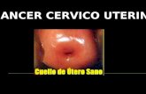 Cancer Cervico Uterino y Mamario