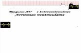 Bloqueos AV e Intraventriculares - Arritmias Ventriculares