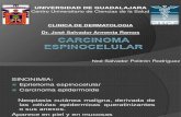 Carcinoma Espinocelular 1