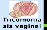 Tricomoniasis Vaginal