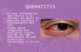 Queratitis Dulce