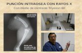 PUNCIÓN INTRAOSEA A TRAVEZ DE RAYOS X