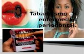 Tabaquismo en enfermedad periodontal