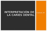 Interpretacion caries dental en Radiologia