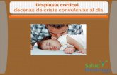 Displasia cortical, ataques de epilepsia en niños