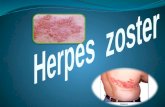 Herpes zoster.