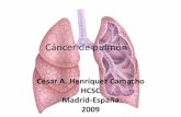 Caso clinico cancer de pulmon
