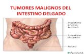Expo Cx Tumores Malignos Del Intestino Delgado