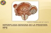 Hiperplasia benigna de la prostata