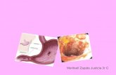 Power point úlceres pèptiques i malaltia de crohn