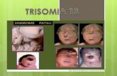 Trisomia 13