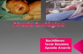 Atresia esofagica en Pediatria