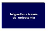 21. Irrigación a través de colostomía