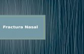 Fractura nasal