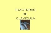 Fracturas De Clavicula