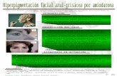 Presentación 062: Hiperpigmentación facial azul-grisácea por amiodarona