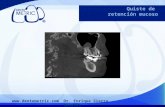Quiste de retención mucoso, casos radiográficos, Dento Metric, Dr. Enrique Sierra Rosales, Radiología oral y maxilofacial