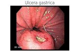 Ulcera gastrica