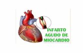 Infarto del miocardio