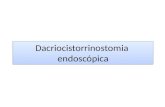 Dacriocistorrinostomia endoscopica
