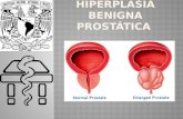 Hiperplasia Benigna Prostática