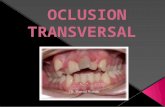 Oclusion Transversal