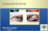 Conjuntivitis 3