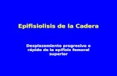 Epifisiolisis de la Cadera Desplazamiento progresivo o rápido de la epífisis femoral superior.