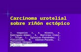 Carcinoma urotelial sobre riñón ectópico I. Vaqueiro I, A. Rivera, A. Rodríguez-Gómez, A. Martínez-Vidal, C. Trigo, L. Iglesias-Fernández, I. Villaverde,