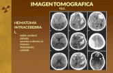 IMAGEN TOMOGRAFICA T.E.C. HEMATOMA INTRACEREBRA L tejido cerebral dañado opuesto o directo al impacto Tratamiento variable.