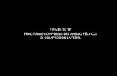 EJEMPLOS DE FRACTURAS COMPLEJAS DEL ANILLO PÉLVICO: 2. COMPRESIÓN LATERAL.