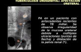 TUBERCULOSIS UROGENITAL: AFECTACIÓN URETERAL PA en un paciente con antecedentes recientes de TB miliar. Se observa irregularidad de la mucosa ureteral.