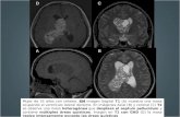 A B D Mujer de 35 años con cefalea. RM imagen Sagital T1 (A) muestra una masa ocupando el ventrículo lateral derecho. En imágenes Axial (B) y coronal (C)