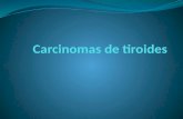 1. Carcinoma papilar 75 al 85 % 2. Carcinoma folicular 10- 20 % 3. Carcinoma medular 5 % Carcinoma anaplásico menos de un 5 %