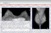 Paciente de alto riesgo con mamas densas, difícil de evaluar por mamografía (a; b). Áreas de realce bilateral tipo non mass “en racimo”, sugestivo de enfermedad.