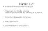 Gustilo IIIA:
