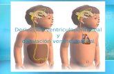 Derivación ventriculoperitoneal y derivación ventriculoatrial