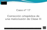 17.- Corrección ortopédica de una maloclusión de Clase II - Rafael Gallardo Galdón